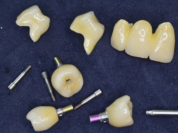 Weber-Zahntechnik - System-Schnittstellenerweiterungen