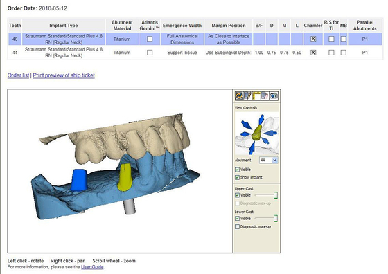 Computergestütze 3D Implantatplanungen
